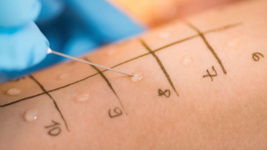 تست‌های آلرژی؛ شناسایی حساسیت‌های پنهان